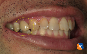 ２年前から保険で白く出来るようになりました