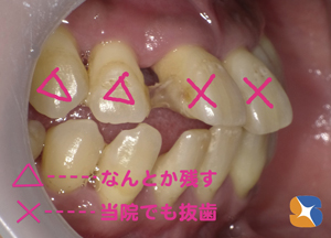 出っ歯　隙っ歯　グラグラ　抜かずにを残す