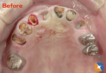 痛くないため長期間放置