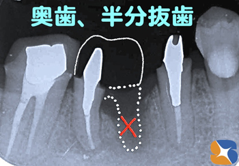 奥歯　半分だけでも残す