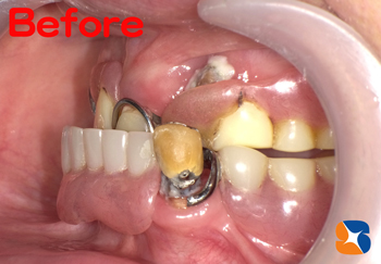 保険でよく噛める入れ歯の相談