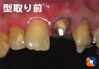 短期できっちり、丁寧に前歯を復元します