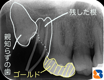 親知らずの周囲への悪影響