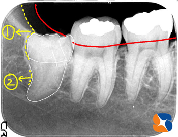 骨に覆われ歯が上がれない
