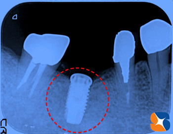 ブローネンマルク　インプラント　奥歯