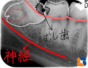 レントゲンで虫歯の有無と深度をチェック