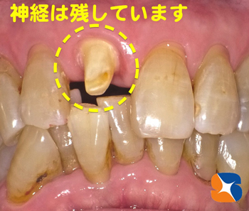 神経を取らずに削って前歯に被せるテクニック
