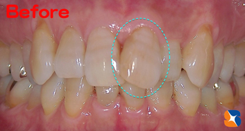 歯並びをセラミックだけで治す