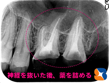上の奥歯２本から神経を抜く