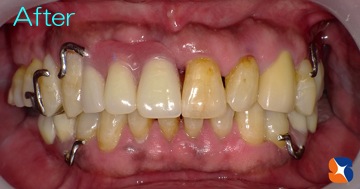 保険の入れ歯なのにデザインは自費の入れ歯