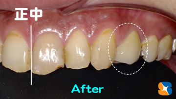 器械が作る白い被せの歯
