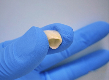 オールセラミック