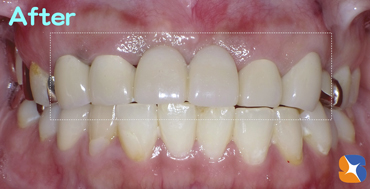 ６連結の前歯のブリッジ　良好な結果に満足