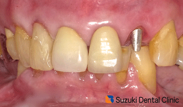 被せる前の状態