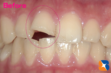 健康な前歯　事故で欠ける　神経を残したい
