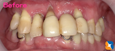 グラつく前歯の抜歯と見た感じの良い入れ歯を希望