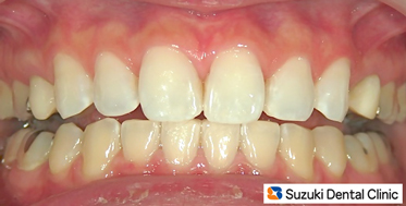 ホワイトニング後にセラミック装着