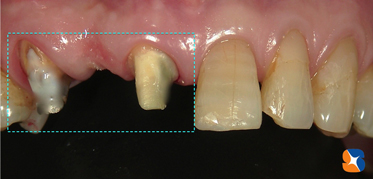 ブリッジを外した状態