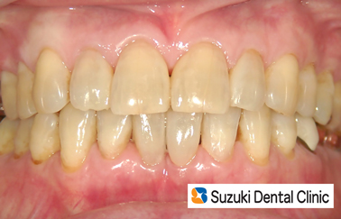 すき間を詰める