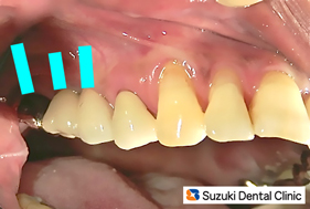 奥に３本のインプラントが完成