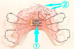 矯正　プレート装置
