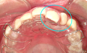 実際に装置の装着