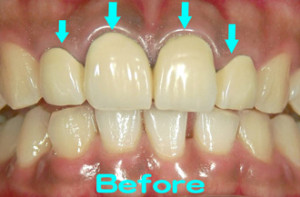 保険　かぶせ物