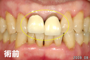 かぶせ物２本を外す前