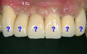 長持ちする前歯の治療
