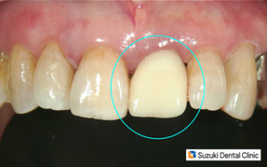 セラミック　より白く　ホワイトニング
