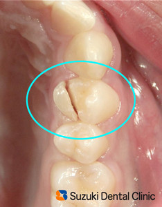 スポーツ　事故　歯が割れた