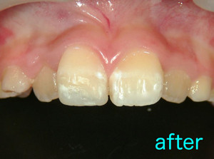 事故　前歯欠ける　白い詰め物　保険