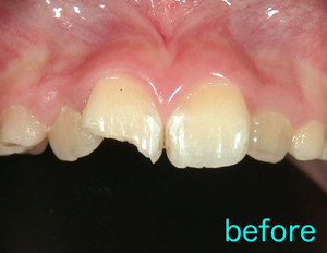 事故　前歯　割れる　痛む