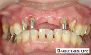 今は歯がありませんが、あと少しでブリッジが装着されます