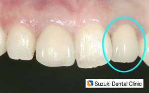 前歯　セラミックの被せ　