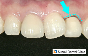 さし歯の際　黒色ライン