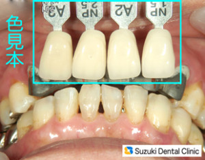 ベストな歯の色を色見本といっしょに照らし合わせる