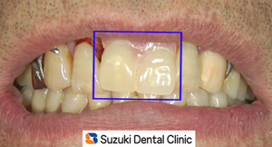初診時の入れ歯の状態
