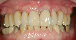 すべてインプラントで出来た歯