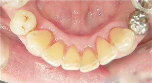 ヤニ取り　保険