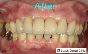 前歯　ブリッジ　セラミック　多数