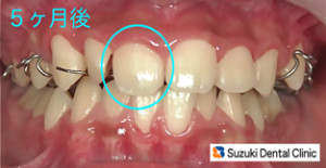 取り外し装置だけで歯並び改善