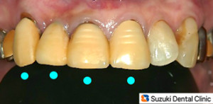 昔のさし歯の黄ばみ