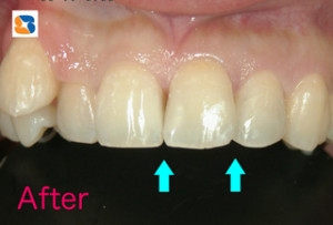 ハイブリッドレジン使用