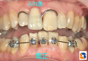 入れ歯と矯正