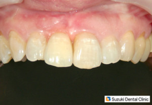 噛めるインプラントから美しいインプラントへ