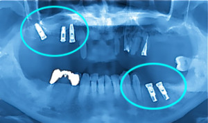 上アゴと下アゴにインプラント