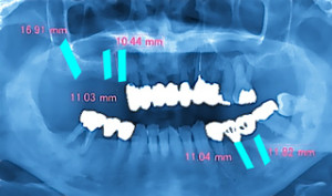インプラント　治療計画