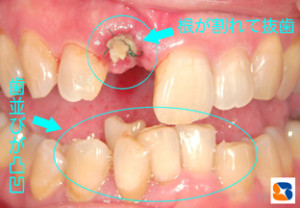 トラブル　根が割れる