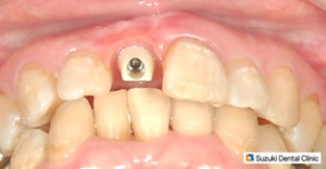 インプラントの土台